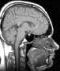 MRI brain scan
